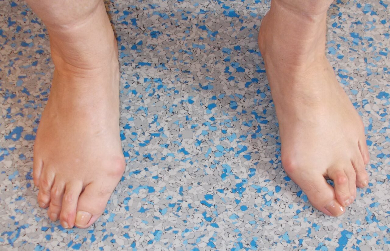 Hallux Valgus FusschirurgiePfleghar